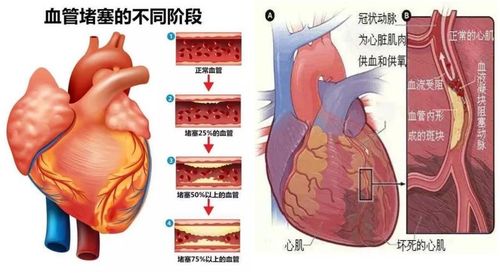 心肌缺血的严重性及其对儿童的影响