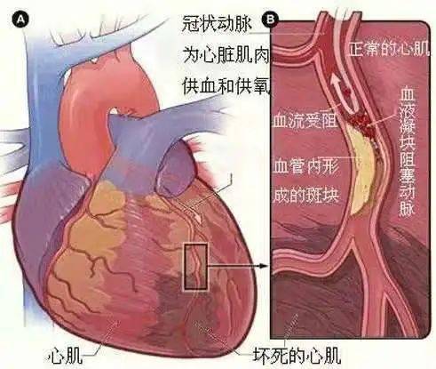 心肌缺血的严重性及其对儿童的影响