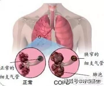 深入了解急性乳腺炎，症状、原因、治疗及预防