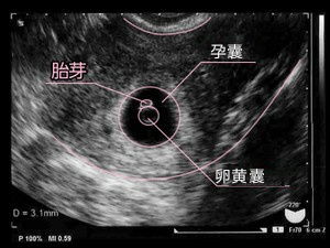 怀孕4个月胎儿B超图，了解宝宝的早期发育