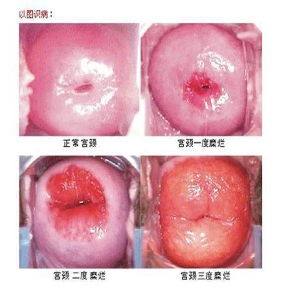 了解宫颈CIN，预防与治疗的关键