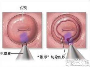 了解宫颈CIN，预防与治疗的关键