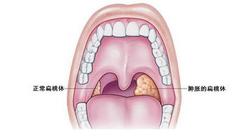 扁桃体化脓，症状、原因与科学应对方法