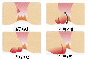 痔疮出血怎么办？轻松搞定的小妙招和专业建议